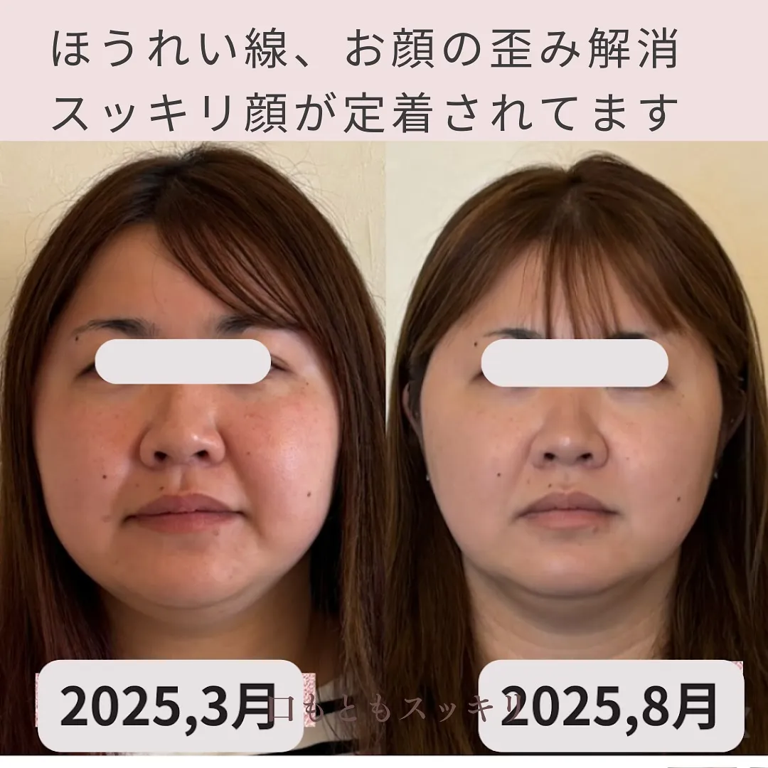 ほうれい線がどこかへ消えた！