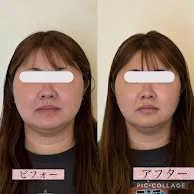 エステで実感する埼玉県越谷市のほうれい線消し方とプロの施術効果を解説