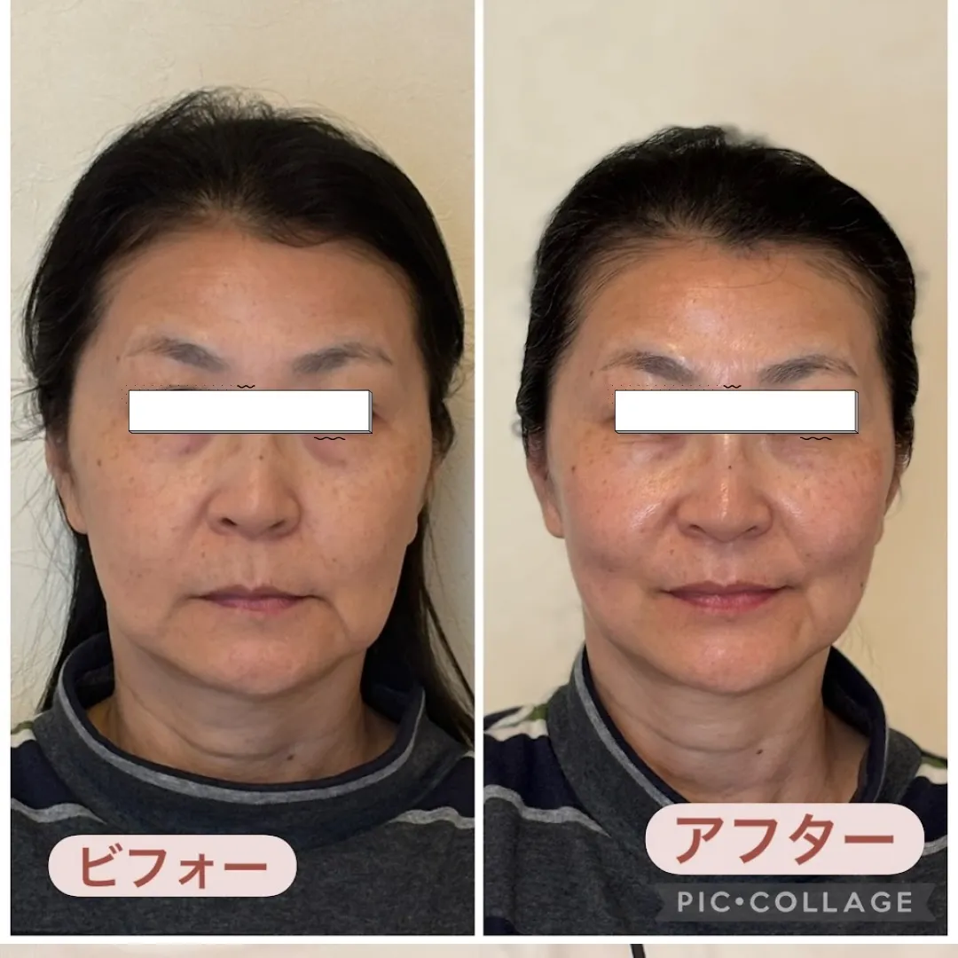 たるみの原因は？